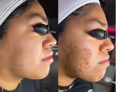 Acne Treatment 1